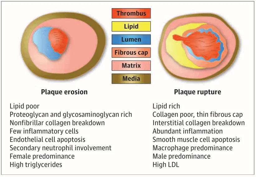 Perbedaan erosi plak dengan ruptur plak aterosklerosis