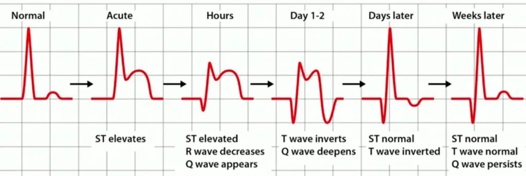 Gambar evolusi pola EKG pada STEMI
