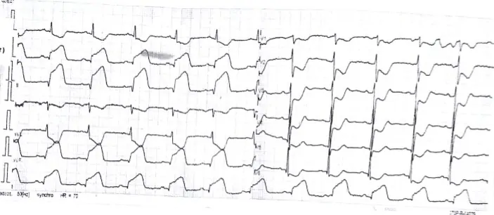 Contoh gambaran EKG pasien dengan STEMI
