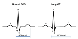 Gambaran EKG pemanjangan segmen QT