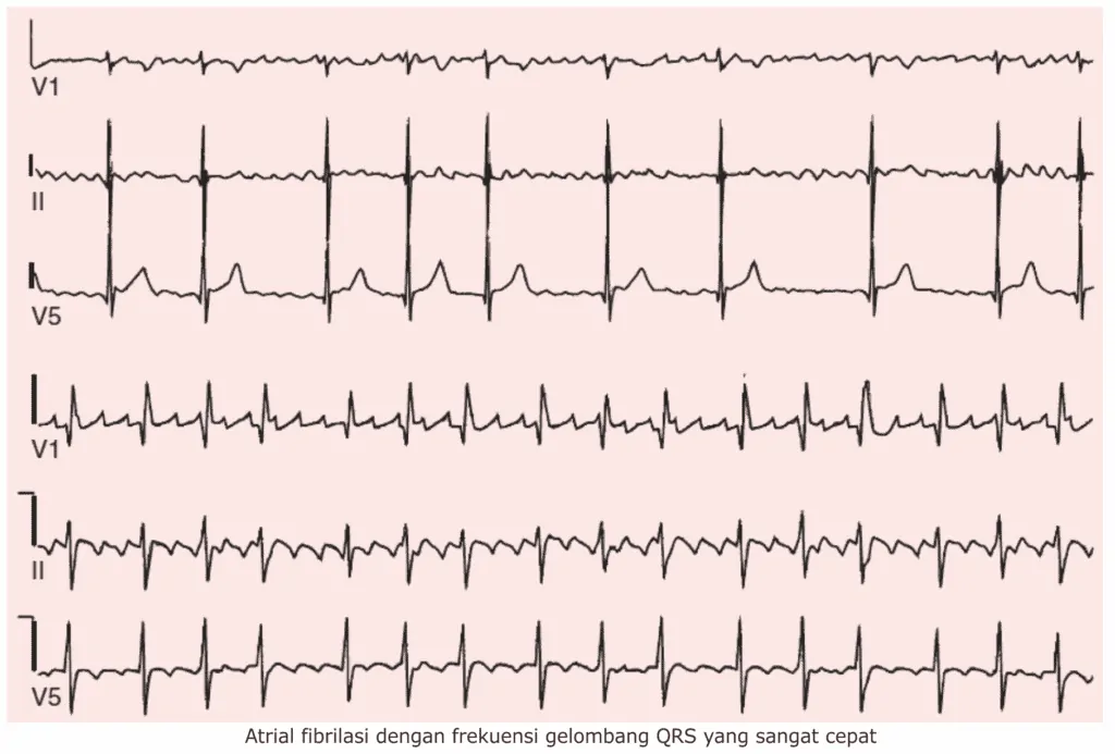 Atrial fibrilasi dengan frekuensi gelombang QRS yang sangat cepat