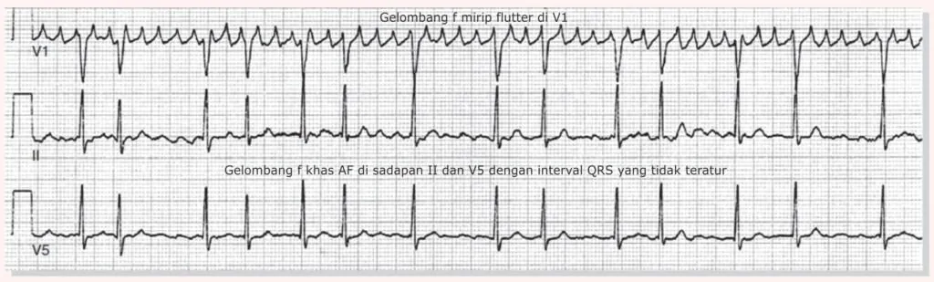 Gambaran AF mirip atrial flutter