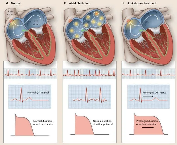 Pengaruh amiodarone pada atrial fibrilasi