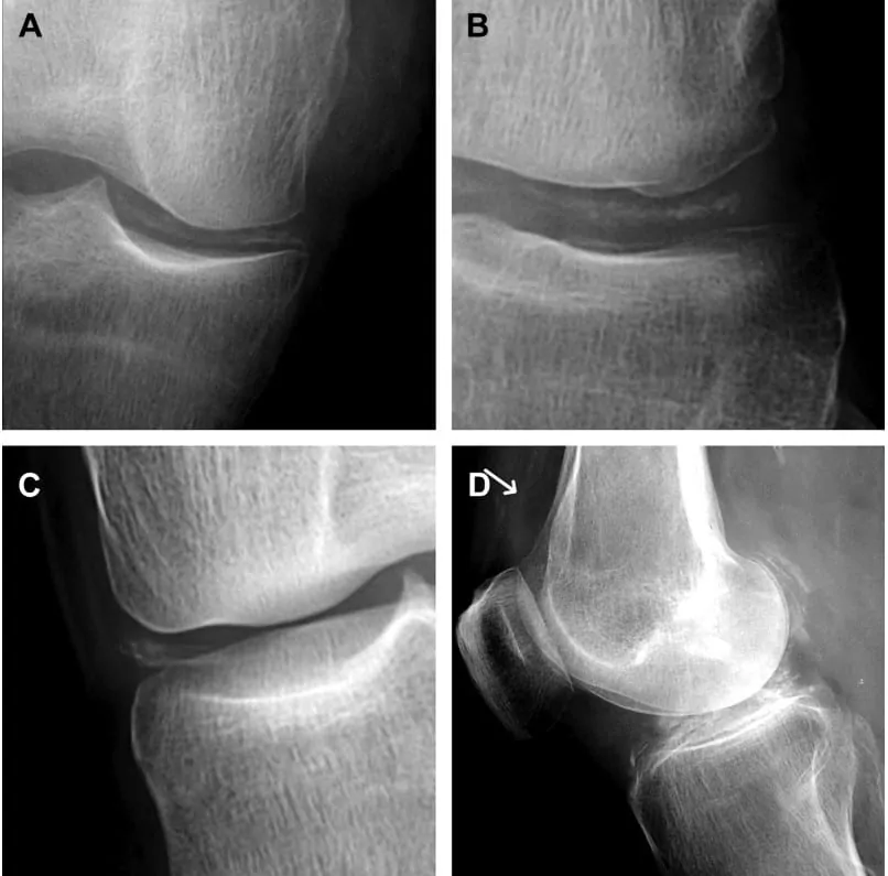 Gambaran radiologis penyakit deposit non gout: CPPD