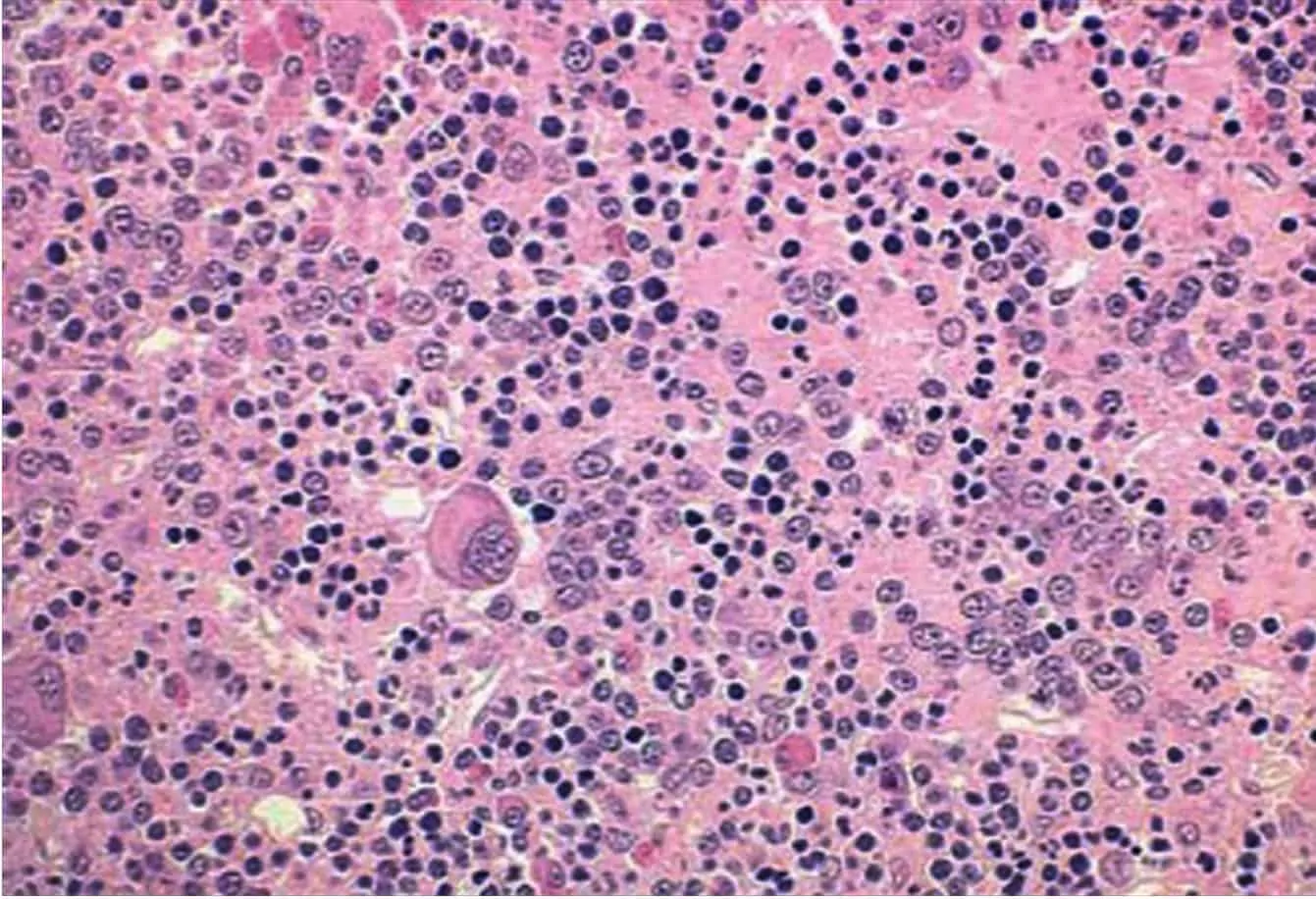 Gambaran sumsum tulang pada polycythemia vera
