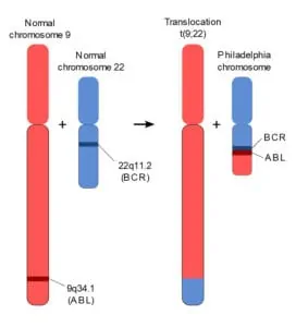 Gambar mekanisme translokasi kromosom yang menghasilkan kromosom Philadelphia