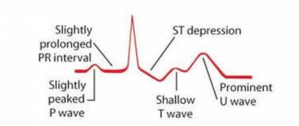 Gambaran EKG kondisi hipokalemia