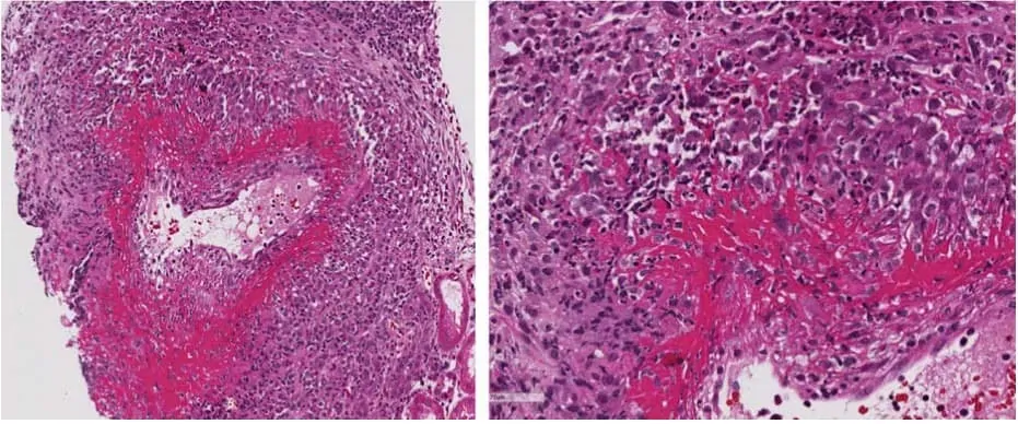 Gambaran histologi kasus AAV tipe  gralunomatosis dengan poliangitis (GPA)