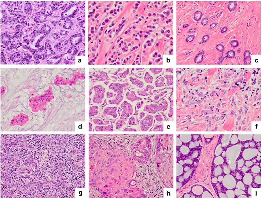 Gambaran mikroskopis atau patologi jenis-jenis kanker payudara