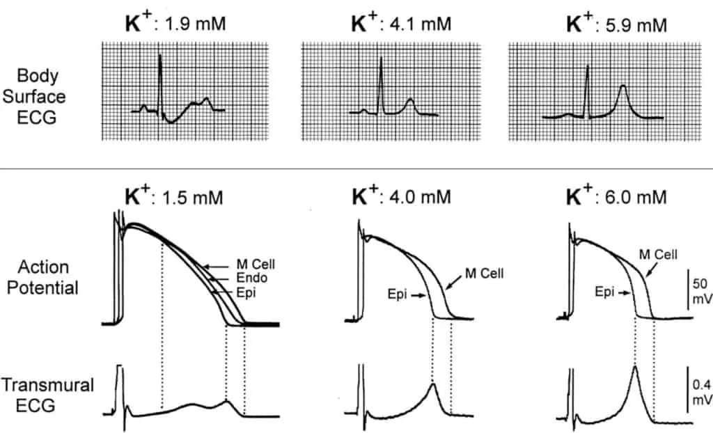 Perbandingan EKG kondisi hipokalemia dengan normokalemia dan hiperkalemia