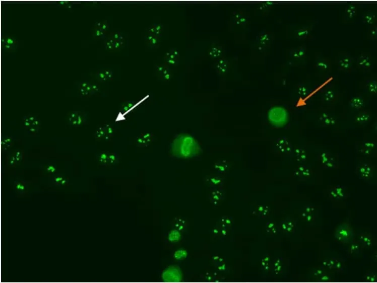 Pola nucleolar ANA-IF