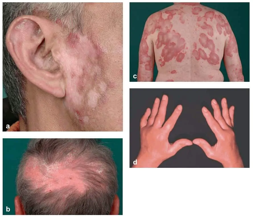 Gambaran dermatologis penyakit lupus