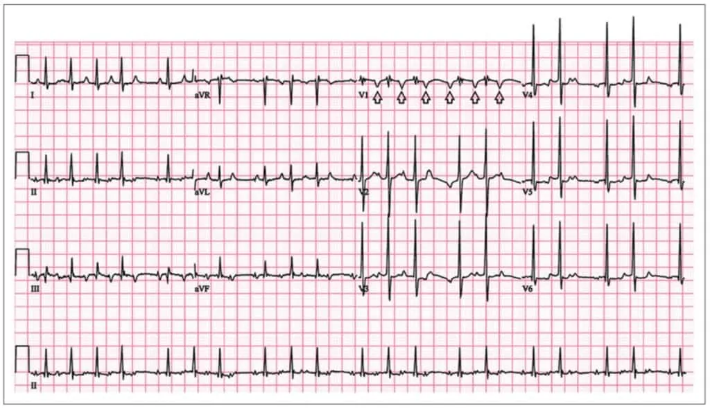 Gambaran EKG kasus SVT