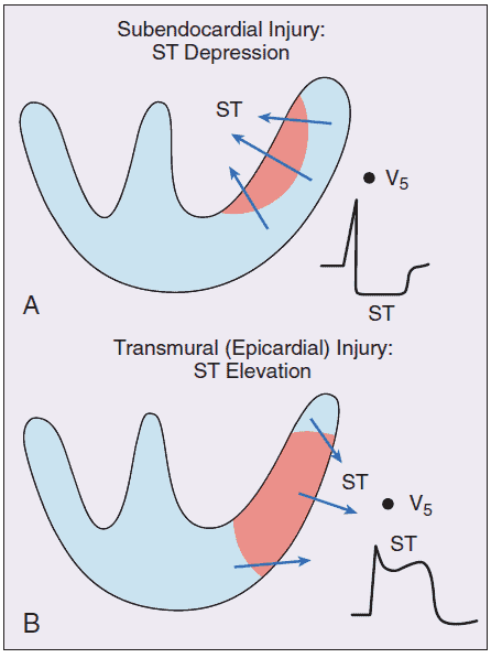 Pola EKG pada iskemia transmural dan iskemia subendokardial.