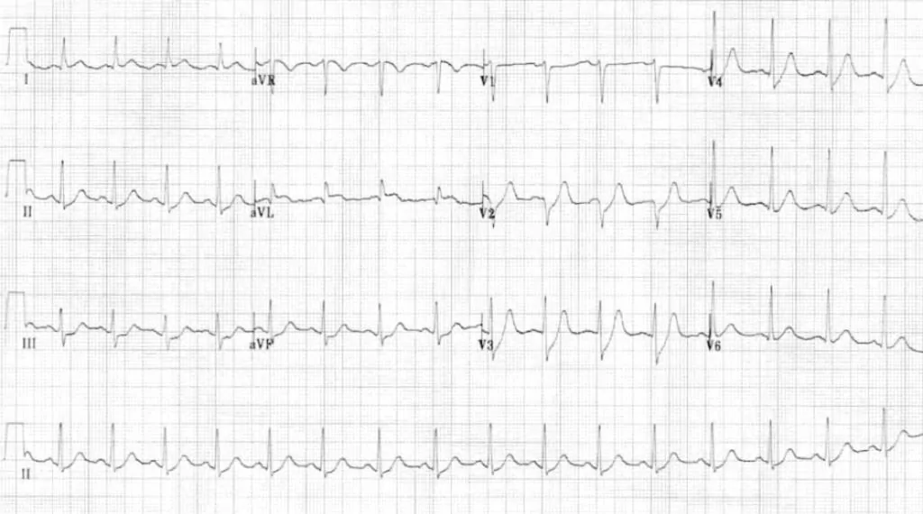 EKG dengan ST depresi terlokalisasi