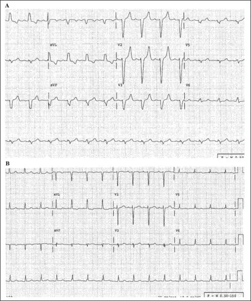 Contoh EKG pada hiperkalemia