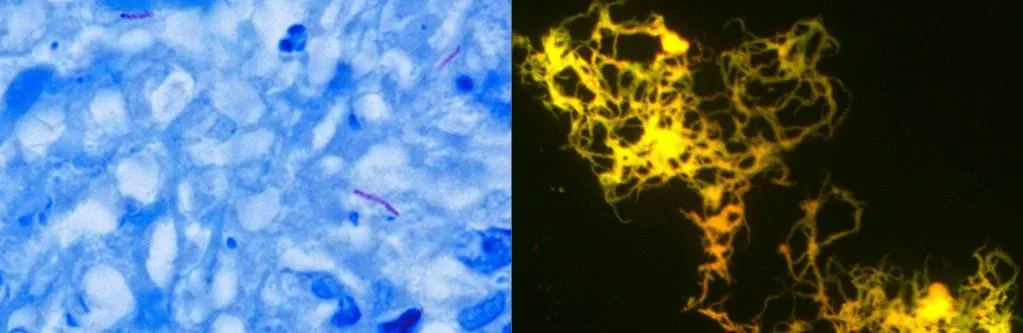 Diagnosis mikroskopis tuberkulosis
