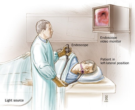 Esofagoduodenoskopi atau endoskopi saluran cerna bagian atas.