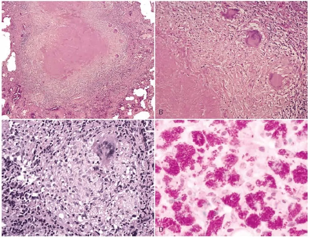 Gambaran mikroskopis lesi granuloma pada tuberkulosis