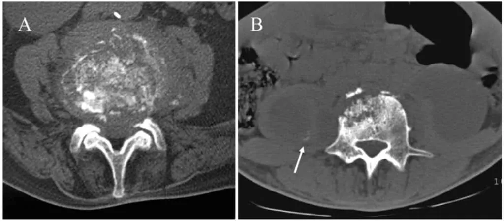 Gambaran CT-scan spondilitis TB
