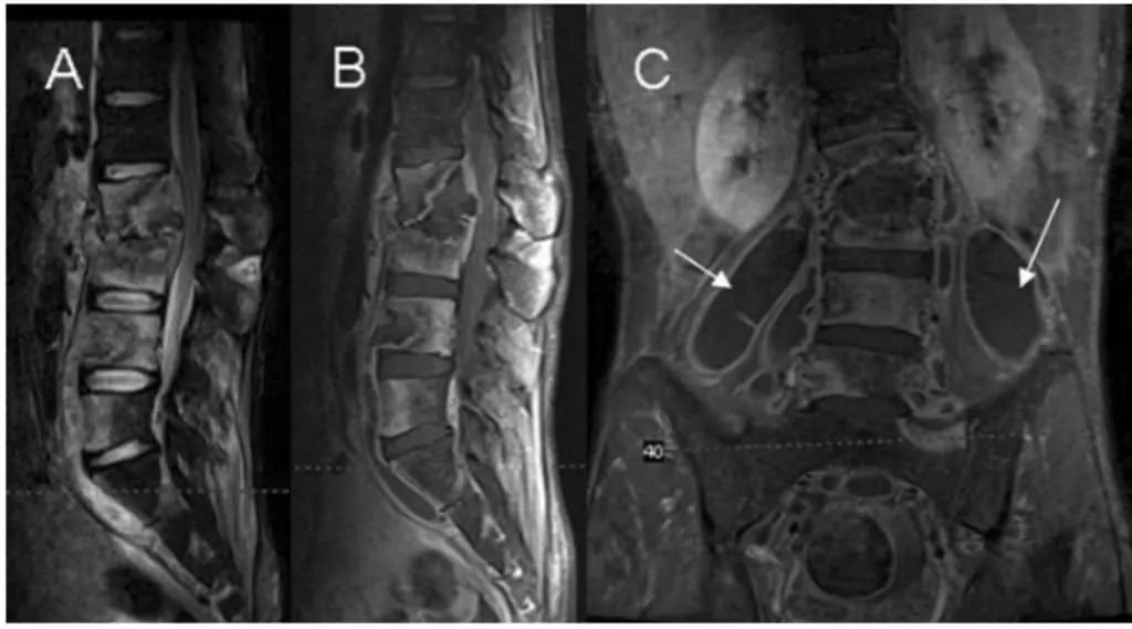 Gambaran MRI spondilitis TB