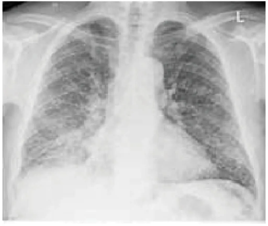 Gambaran TB paru milier