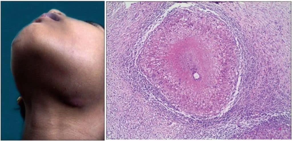 Pembesaran KGB submandibula dan gambaran histologis pada KGB