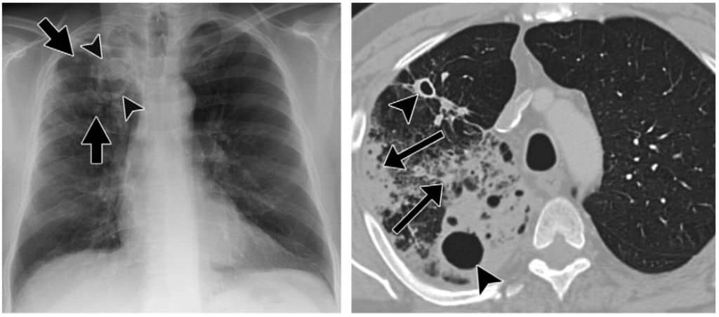 Gambaran foto toraks dan CT-scan tuberkulosis paru pascaprimer. 